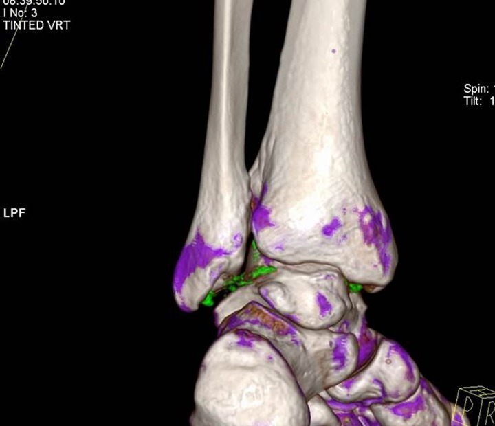 A Beginner’s Guide to Crystal Arthropathies