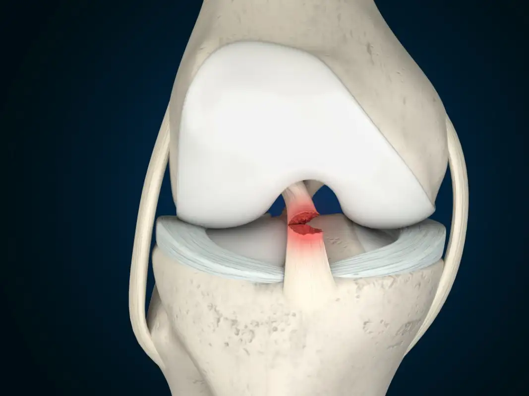 Anterior Cruciate Ligament (ACL) of the knee