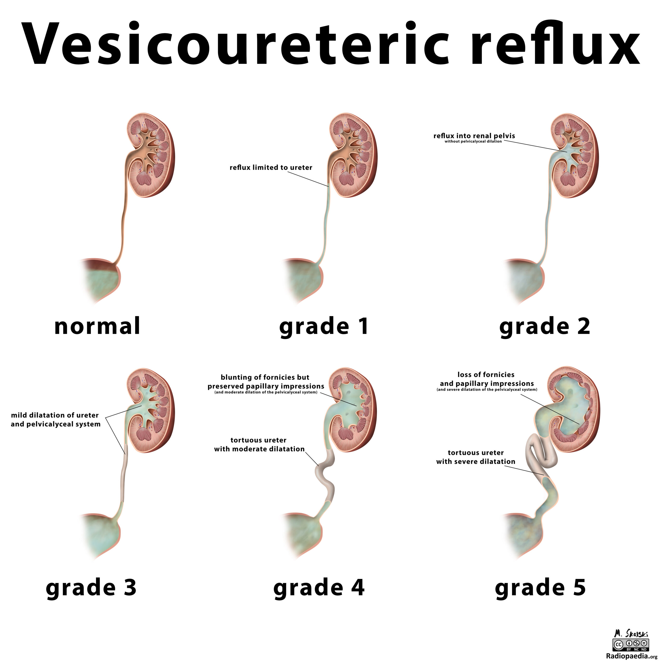 Q&A: Vesicoureteral Reflux (VUR)